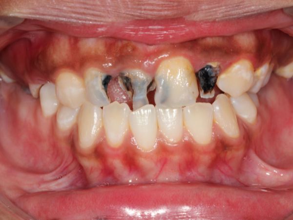 Cárie dentária: remoção seletiva do tecido cariado – Vale a pena? Do que se trata?