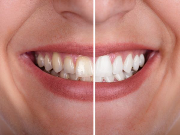 dentes brancos após clareamento