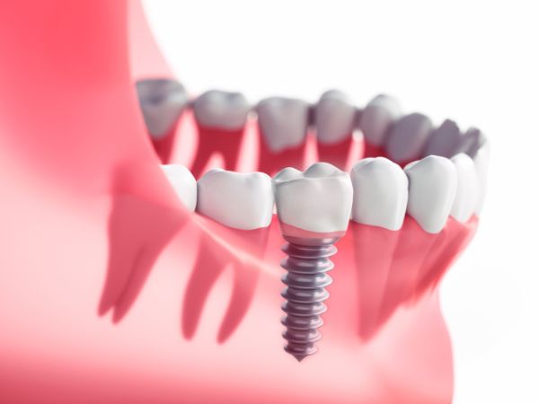 Implante dentário: preço e o que mais você precisa (e quer) saber