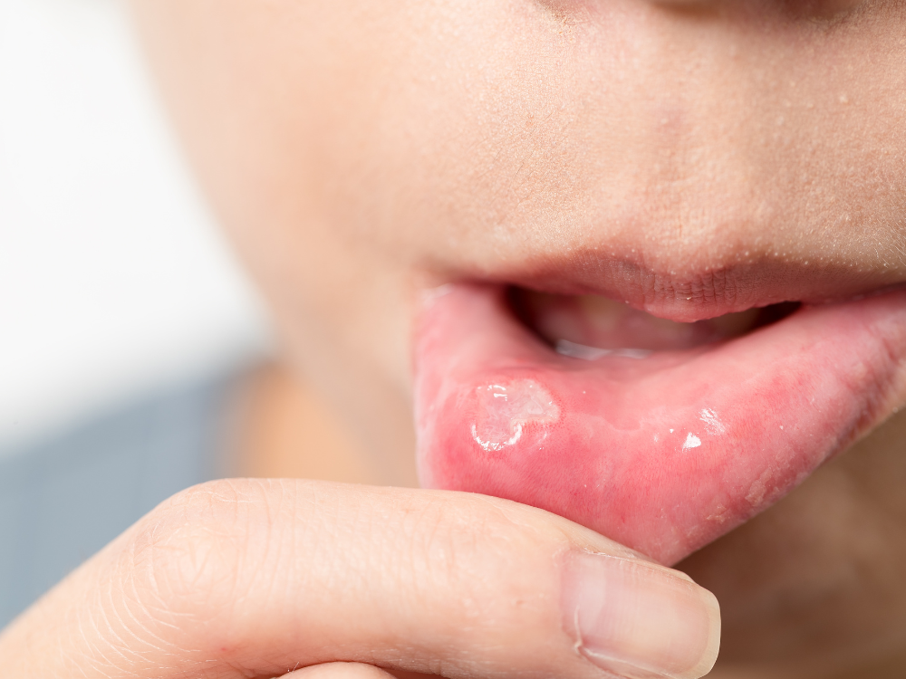 Lesão bucal: Sintomas, causas, tratamentos e muito mais!