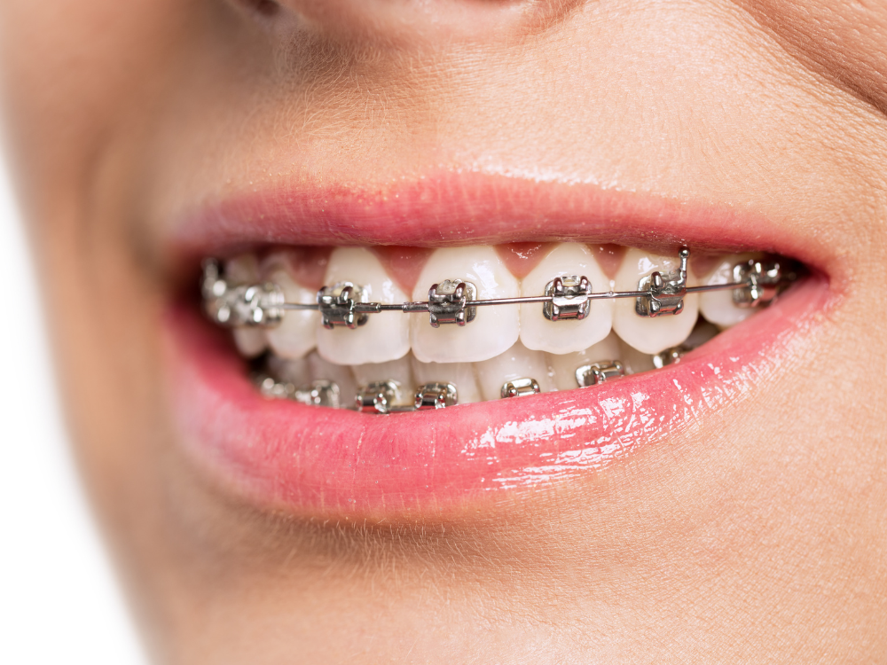Tipos de aparelhos dentários: Entenda tudo!
