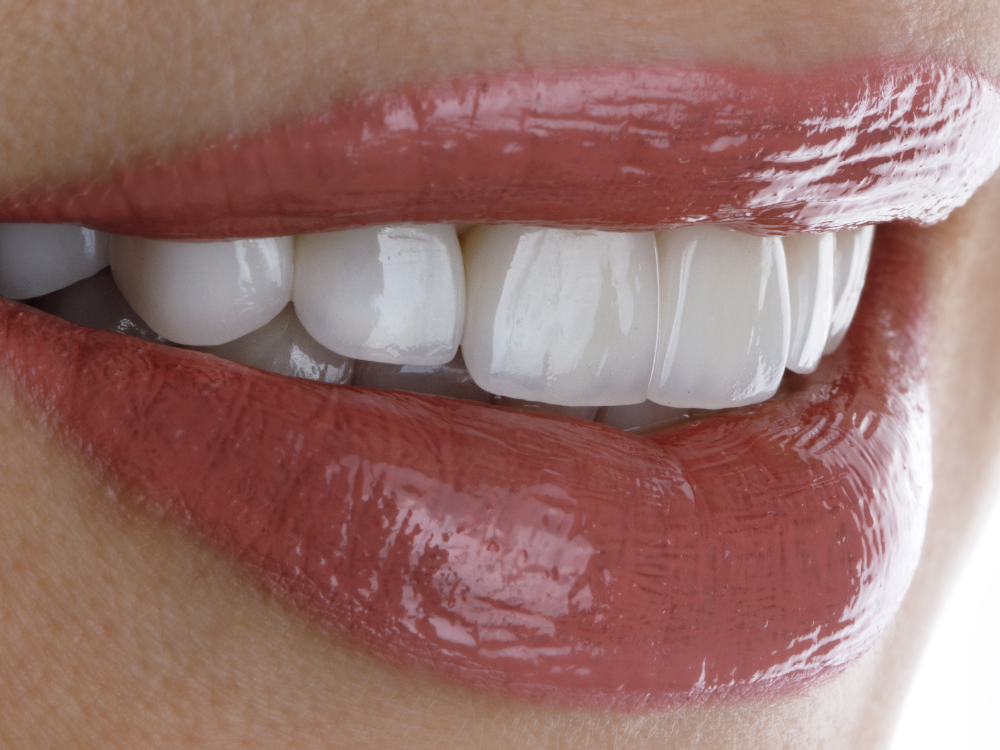 Dentes de porcelana: Tudo o que você precisa saber
