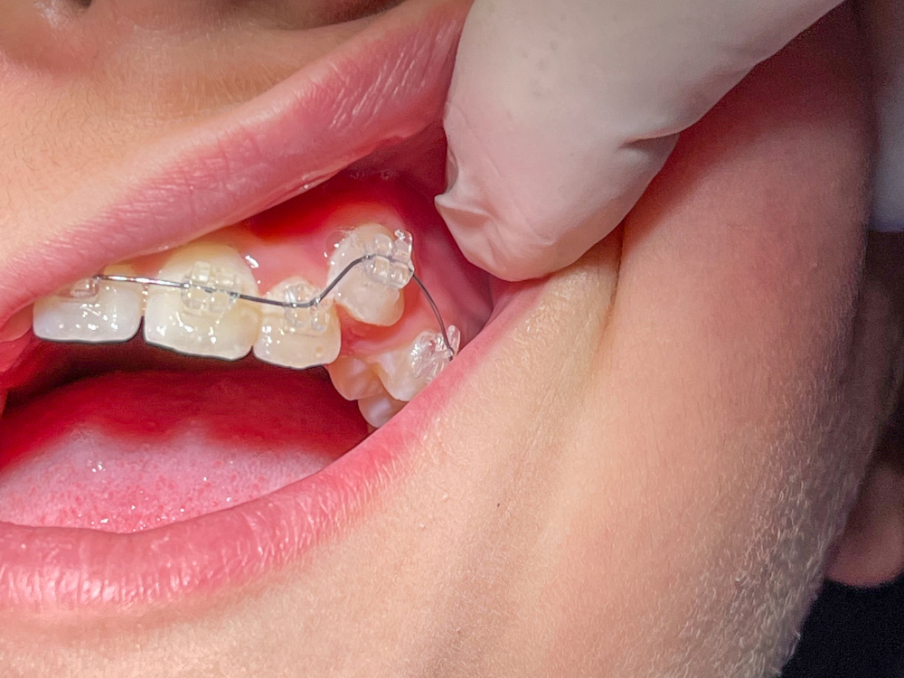 Dente encavalado: entenda as causas e opções de tratamento